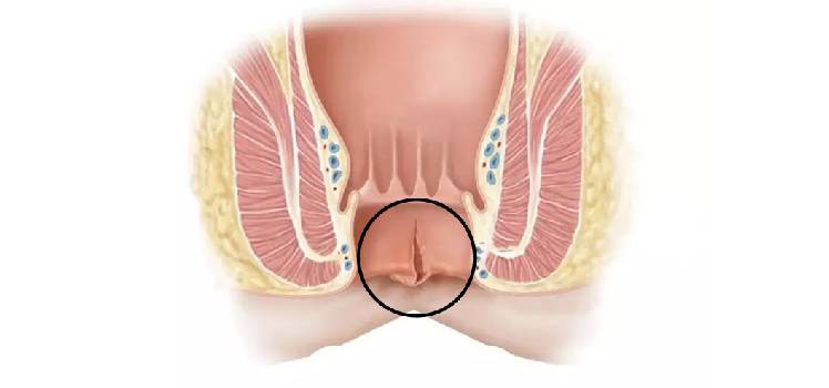 Fissure Treatment in Andheri, Jogeshwari & Vasai