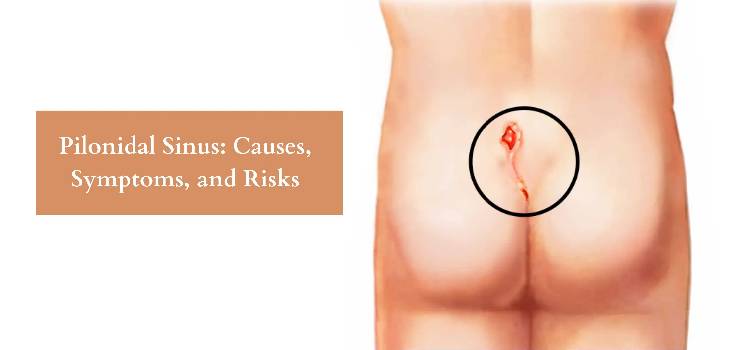 Ayurvedic treatment for Pilonidal Sinus
