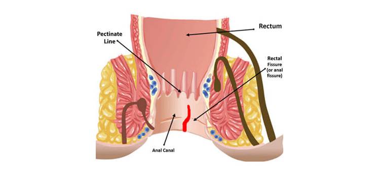 Ayurvedic treatment for Anorectal Diseases