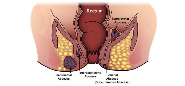 Trusted Fistula Doctor in Andheri Jogeshwari Vasai